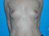 Breast Implants