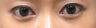Bilateral Lower Blepharoplasty