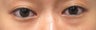 Bilateral Lower Blepharoplasty