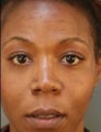 African American Female Rhinoplasty 