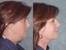 Facelift