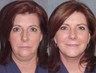 Facelift