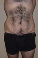 Body Lift