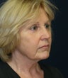 Six Weeks after facelift