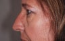 Eyelid Surgery