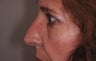 Eyelid Surgery