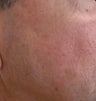 Age Spots Treatment