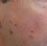 Age Spots Treatment