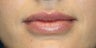 Lip filler with Juvederm