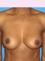 Breast Augmentation