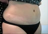 Tummy Tuck