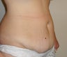 Tummy Tuck