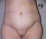 56 year old woman has Belt Lipectomy