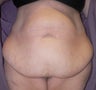 56 year old woman has Belt Lipectomy