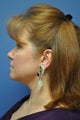 Smartlipo of chin