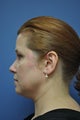 Smartlipo of chin