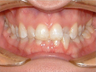 Invisalign