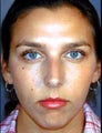 Female Primary Rhinoplasty 