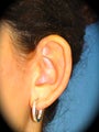 Otoplasty