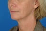 60 year old female who wanted improvement in her jawline and neck.