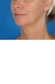 60 year old female who wanted improvement in her jawline and neck.