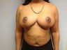 Breast Reduction with Lift