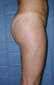 Butt Augmentation