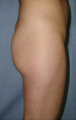 Butt Augmentation