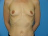 33 yr old with Silicone gel breast implants