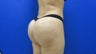 31 year old fat grafting to butt and hips - side view