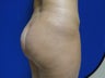 31 year old fat grafting to butt and hips - side view