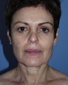Facelift