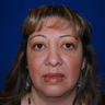 Brow Lift