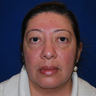 Brow Lift