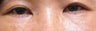 Bilateral Lower Blepharoplasty