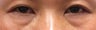 Bilateral Lower Blepharoplasty