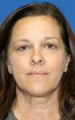Upper & Lower Blepharoplasty and Skin Pinch