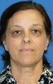 Upper & Lower Blepharoplasty and Skin Pinch