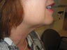 Neck Liposuction. Before and After