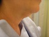 Neck Liposuction. Before and After