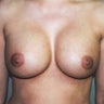 Breast Augmentation