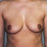 Breast Augmentation