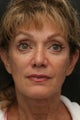 53 year old woman who had a mid face lift and a cheek lift , two type of mini lifts