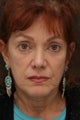 53 year old woman who had a mid face lift and a cheek lift , two type of mini lifts