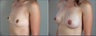 Breast Augmentation