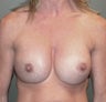 42 Year Old Female Treated For Breast Implant Rerplacements