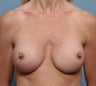 42 Year Old Female Treated For Breast Implant Rerplacements