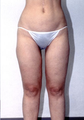 Liposuction