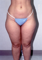 Liposuction