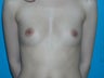 24 yr old woman for saline Breast Augmentation